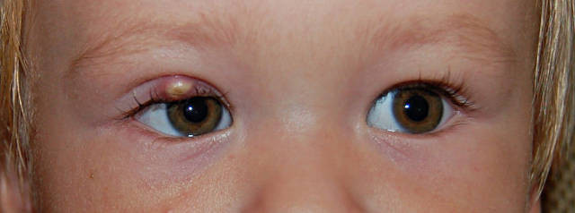 Наращивание глаза ребенка (верхнее или нижнее веко)