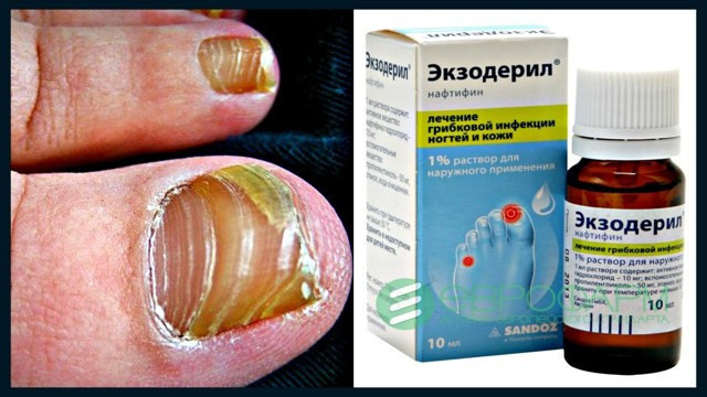 Как лечить грибок ногтей: лекарства, мази, лазер и народная медицина против грибка ногтей